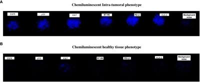 A new method for oral cancer biomarkers detection with a non-invasive cyto-salivary sampling and rapid-highly sensitive ELISA immunoassay: a pilot study in humans